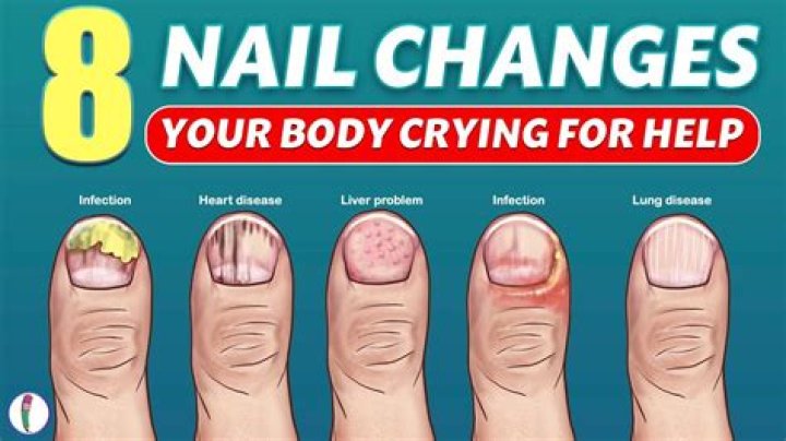 Can diabetes affect your nails?