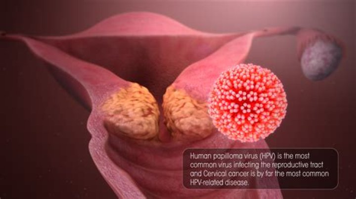 Can HPV cells be removed?