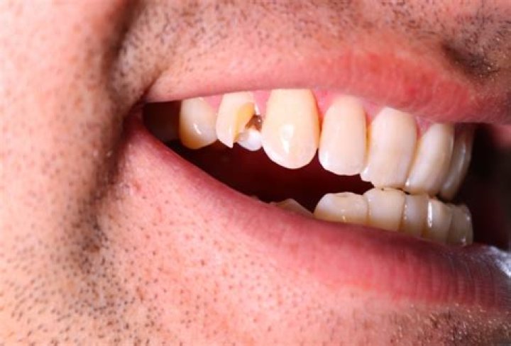 Can I wait a week with a cracked tooth?