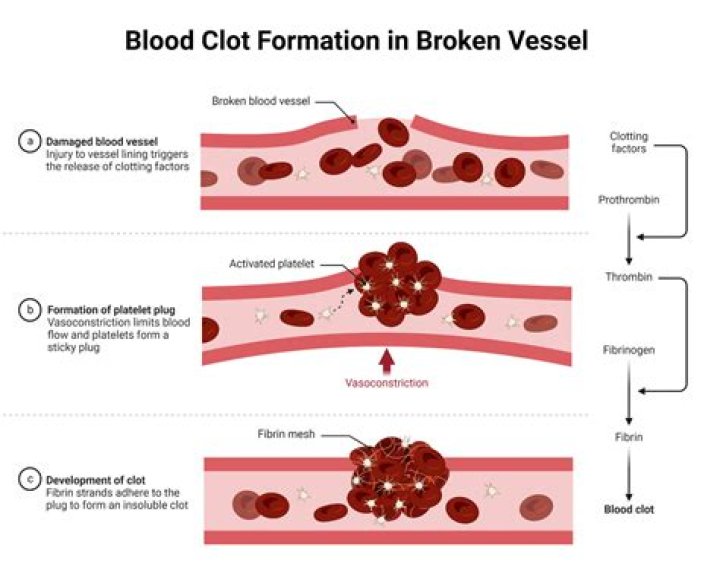 Can you feel a traveling blood clot?