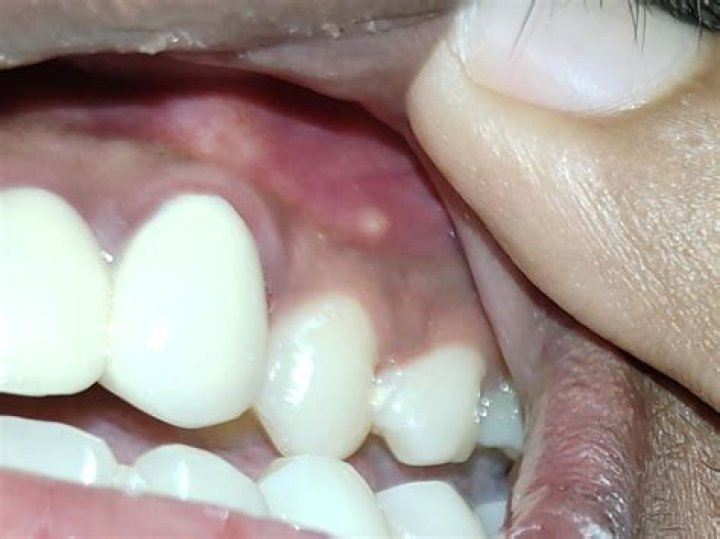Can you get a zit inside your mouth?