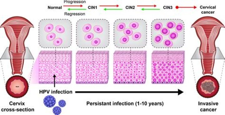Can you have CIN 1 without HPV?