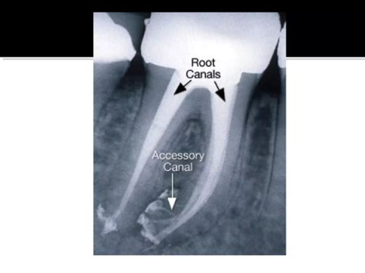Do all cavities need root canals?