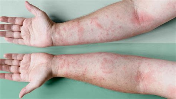 Does eczema get worse as you age?