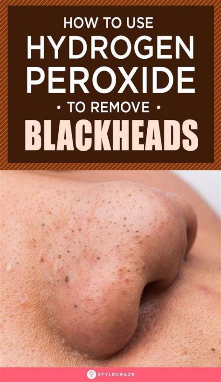 Does hydrogen peroxide dissolve blackheads?