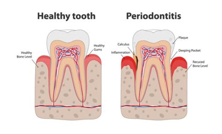 Does periodontitis hurt?