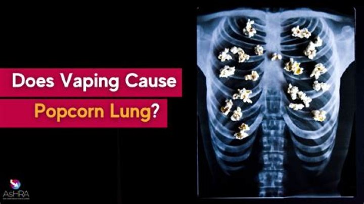 Does vaping cause mono?