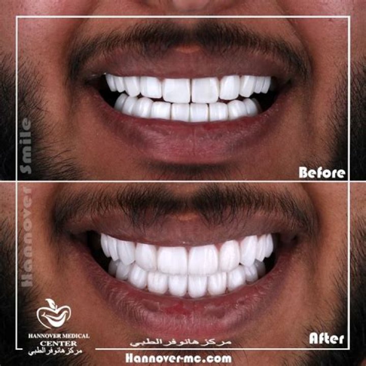 How can I numb my tooth?