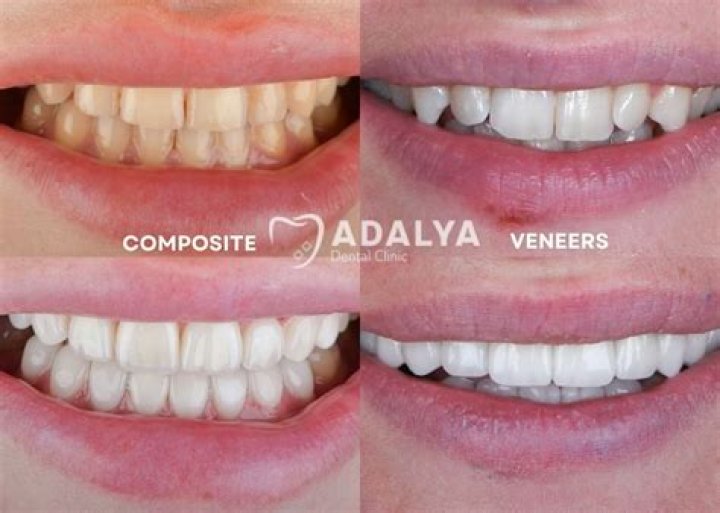 How do I make my composite veneers white again?