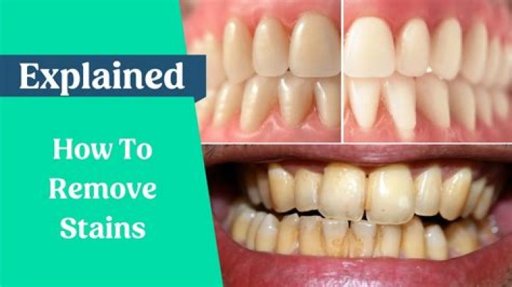 How do you remove stains from composite teeth?