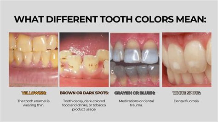 How important is white teeth?