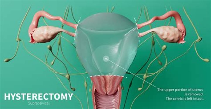 Is a hysterectomy a high risk surgery?