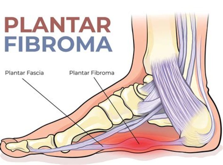 What doctor treats plantar fibroma?