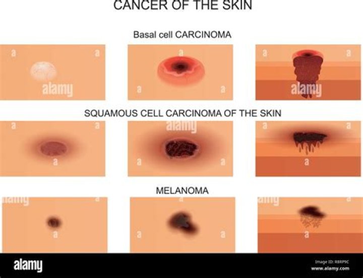 What does necrotic skin look like?