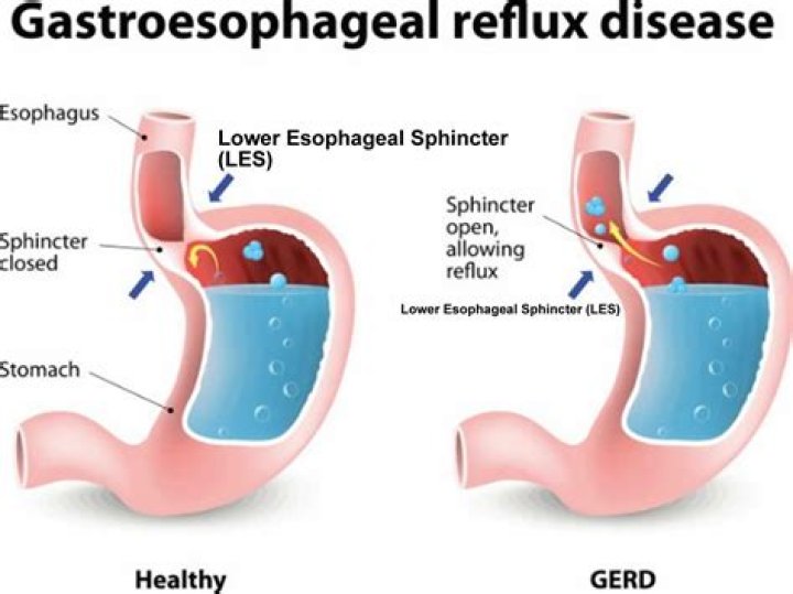 What does pill esophagitis feel like?