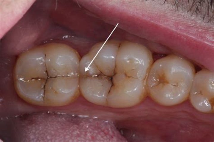 What happens if you leave a broken tooth?