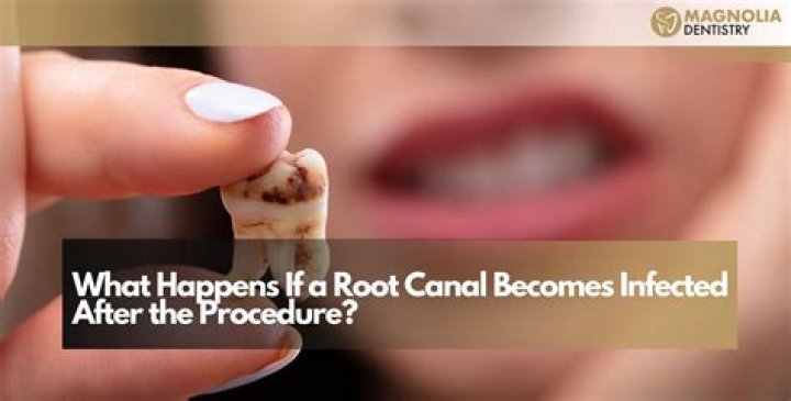 What happens on second root canal visit?