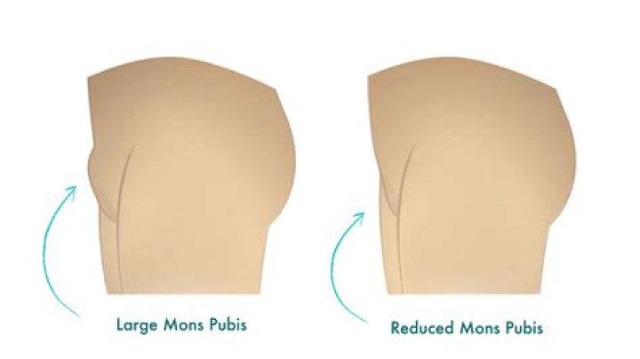 What is a FUPA on woman?