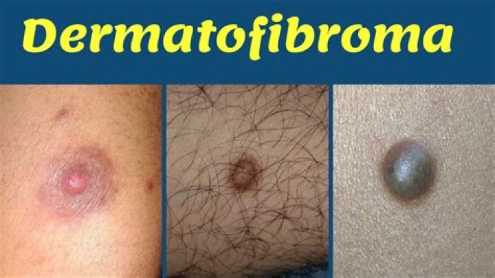 What is an atypical dermatofibroma?