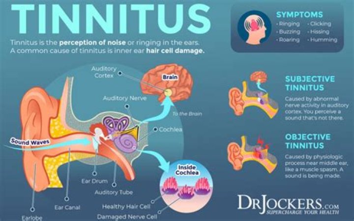 What is severe tinnitus like?