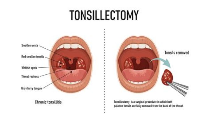 What is the fastest way to recover from a tonsillectomy?