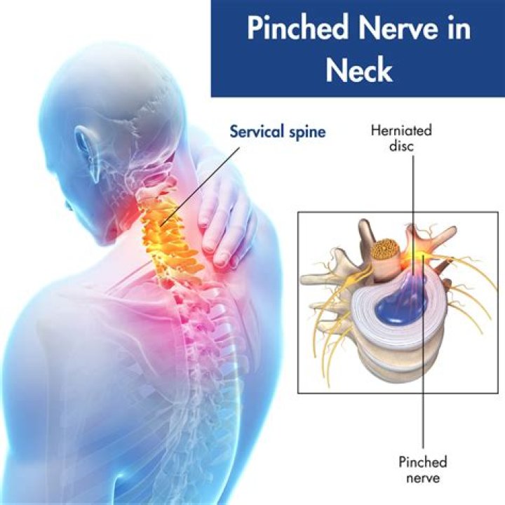 When is a pinched nerve serious?
