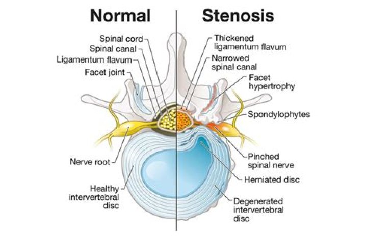 Where do you feel spinal stenosis pain?