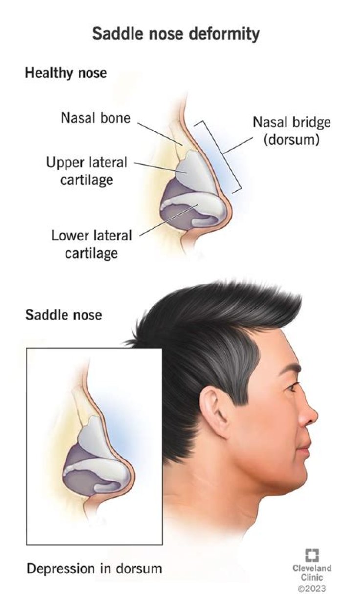 Why is my nose so flat?